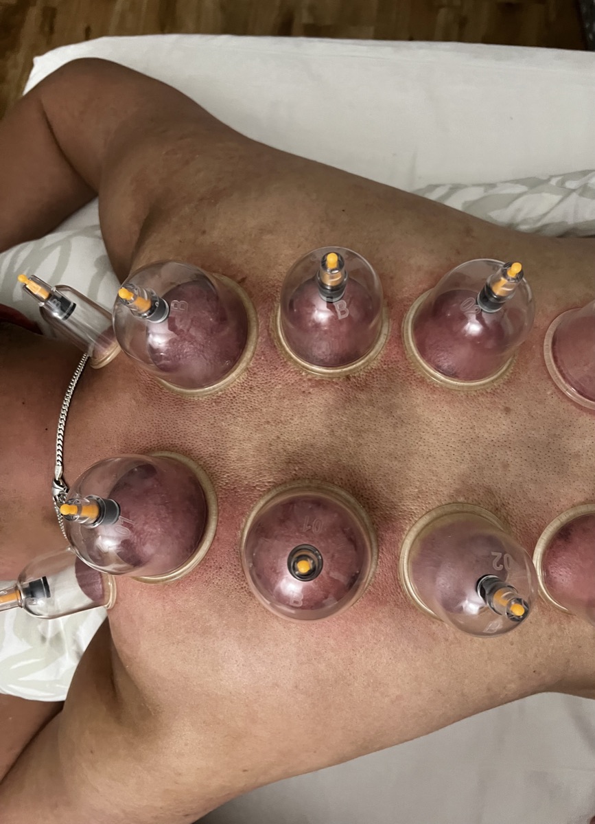 Cupping Therapy technique at Relief Pointe